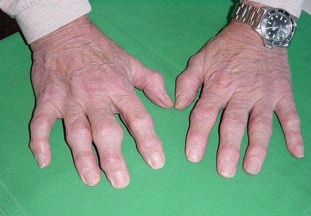 Osteoartritis jari