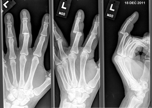 X-ray jari yang terkeluar