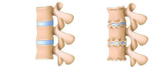 Mekanisme perkembangan osteochondrosis