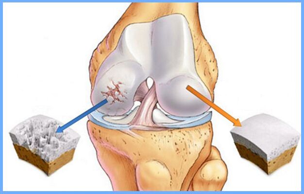 Sendi lutut normal dan terkena osteoartritis