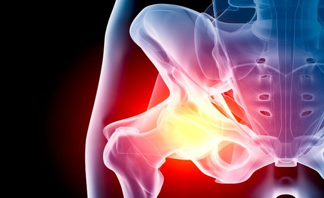 Osteoartritis sendi pinggul