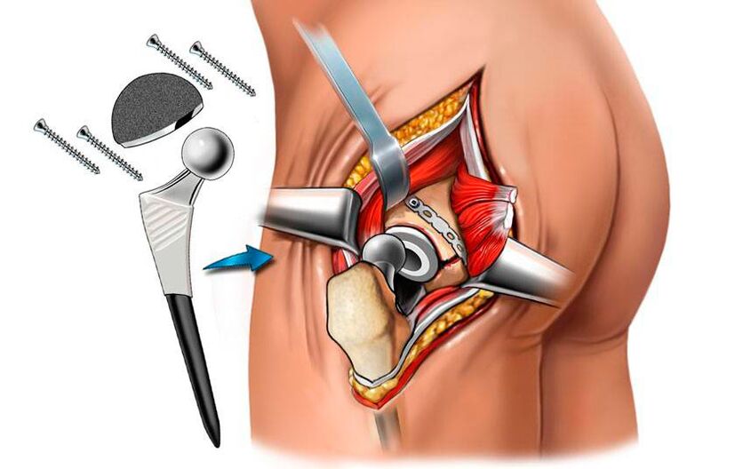 Pemasangan endoprosthesis - penyelesaian pembedahan untuk masalah coxarthrosis