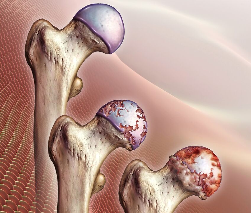 Perkembangan osteoarthritis sendi pinggul