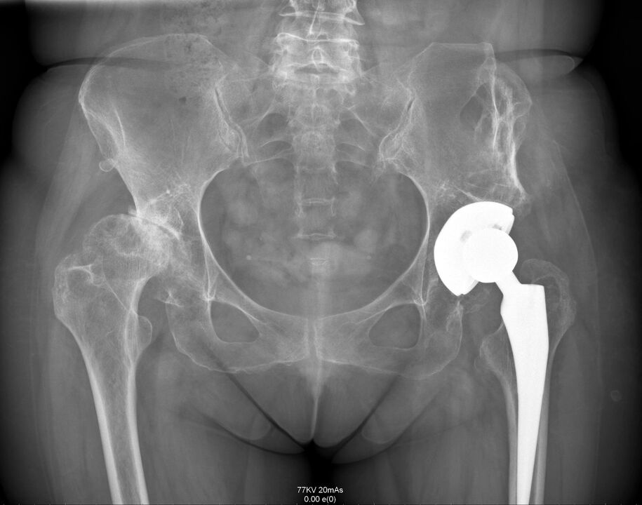 X-ray sendi pinggul selepas endoprostetik