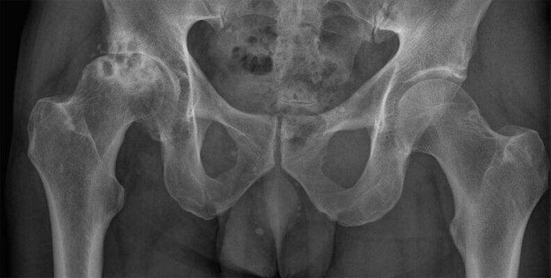 X-ray ubah bentuk arthrosis sendi pinggul