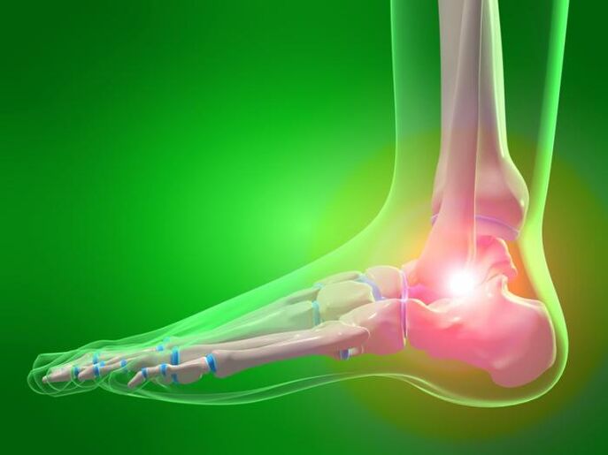 Keradangan pergelangan kaki dengan arthrosis