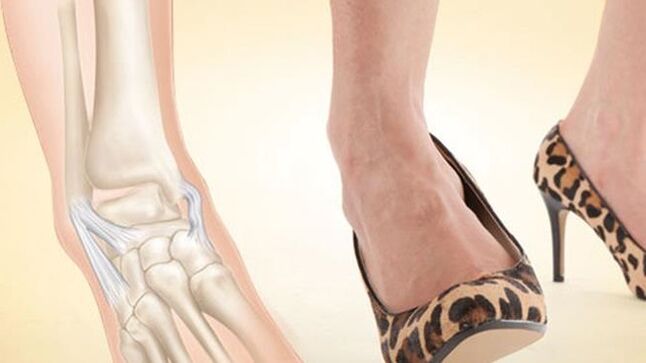 Memakai kasut tumit sebagai punca osteoarthritis buku lali