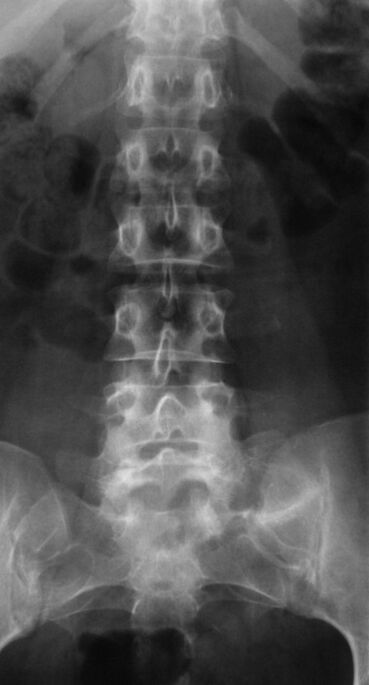 Untuk mendiagnosis osteochondrosis lumbar, x-ray dilakukan