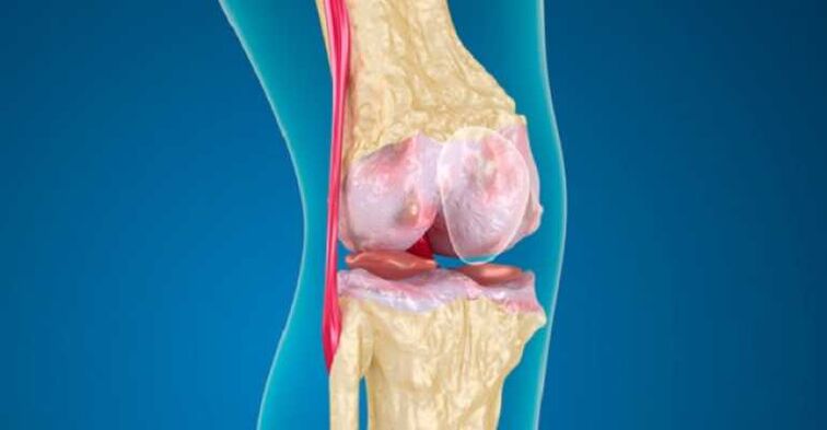 Arthrosis penyakit lutut, yang menyebabkan kemusnahan tulang rawan di sendi
