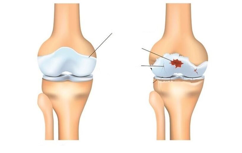 Sihat dan sabar dengan sendi arthrosis