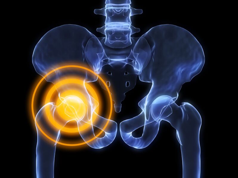 Osteoartritis sendi pinggul