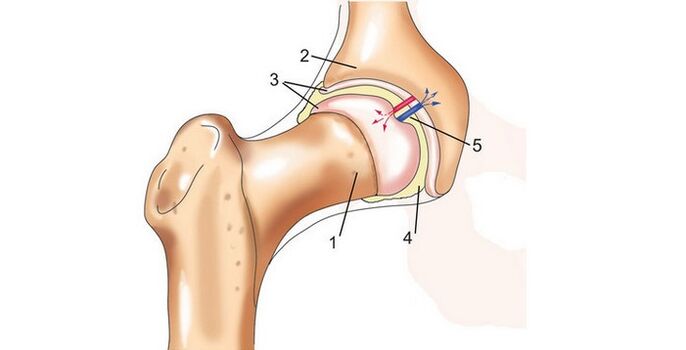 Sendi pinggul dan osteoarthritis