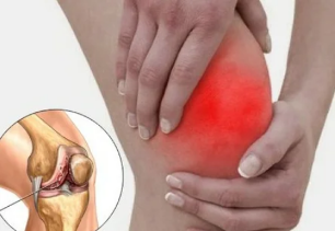 Apa yang terjadi ketika artritis