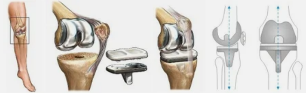 Endoprosthesis untuk lutut contoh